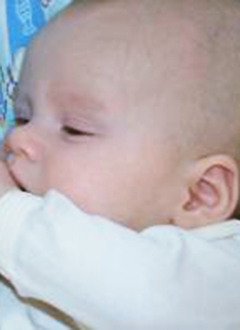 Матвей Камакин, 11 месяцев, воронкообразное отслоение сетчатки глаз, болезнь Норри, потеря зрения,, требуется операция в Мичиганском университете (Энн-Арбор, Мичиган, США), <nobr>6,750.00 USD</nobr>